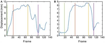 The Dynamic Features of Lip Corners in Genuine and Posed Smiles